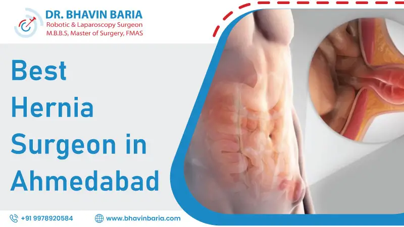 Best Hernia Surgeon in Ahmedabad