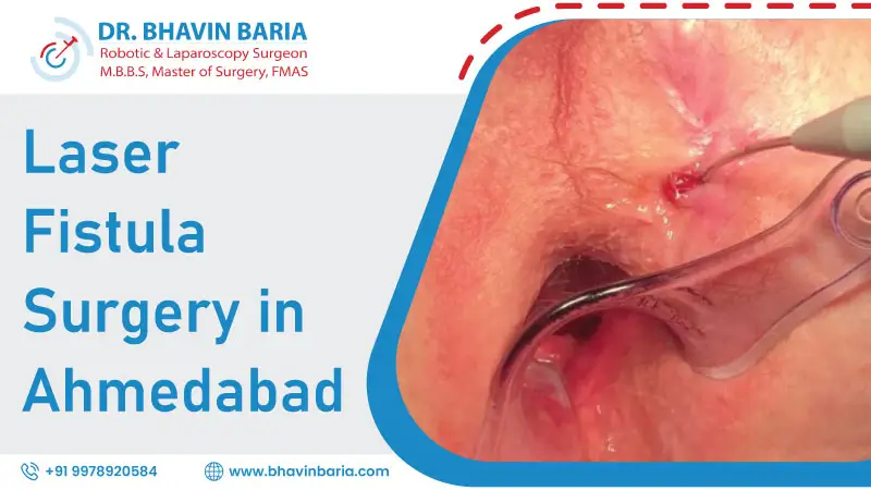 Laser Fistula Surgery in Ahmedabad