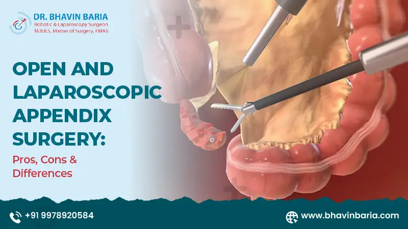 Open and Laparoscopic Appendix Surgery: Pros, Cons & Differences