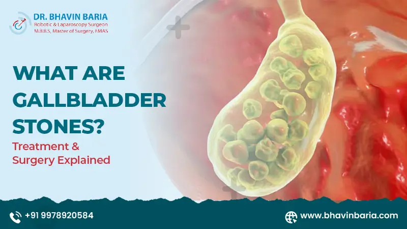 What Are Gallbladder Stones? Treatment & Surgery Explained
