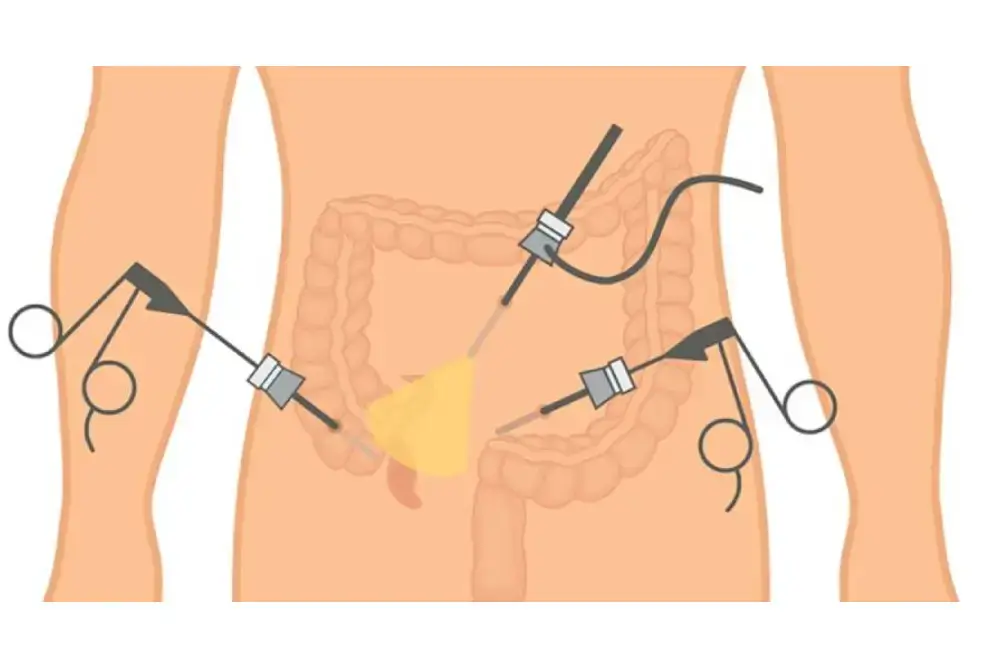When Does Appendix Pain Become Dangerous? Discover How Surgery Helps