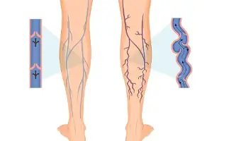 Varicose Vein Treatment in Ahmedabad